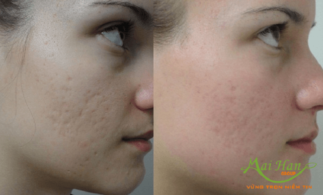 Hiệu quả sau khi sử dụng CO2 Fractional laser Hiệu quả sau khi sử dụng CO2 Fractional laser